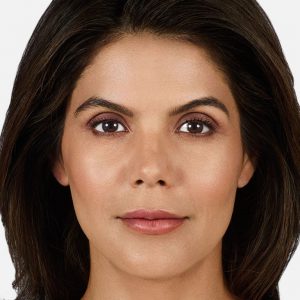 juvederm volbella after photo