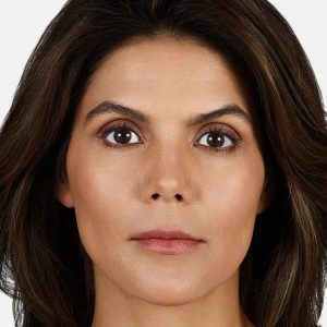 juvederm volbella before photo
